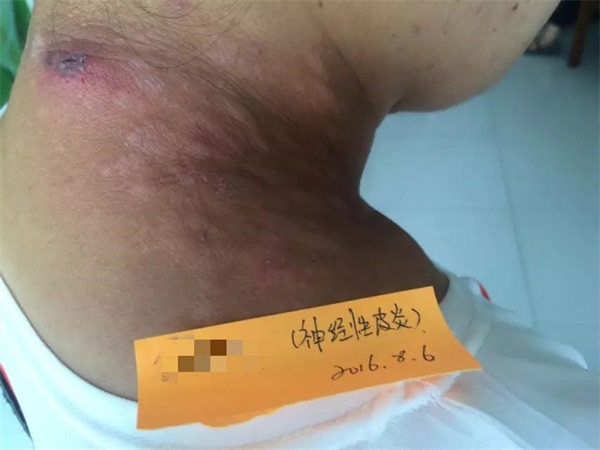 神经性皮炎